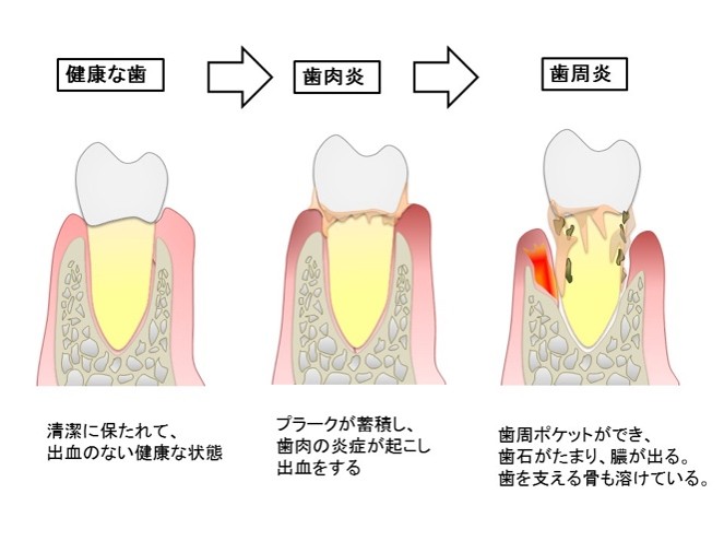 歯周病の進行を3段階で示した図。左から順に、健康な歯（清潔に保たれて出血のない健康な状態）、歯肉炎（歯の根元にプラークが蓄積し、歯肉の炎症を起こして出血する状態）、歯周炎（歯周ポケットができ歯肉の炎症が進み、歯を支える骨が溶ける状態）。右に行くほど歯周病が進行している。