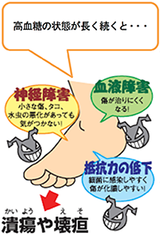 フットケアはなぜ大切なの