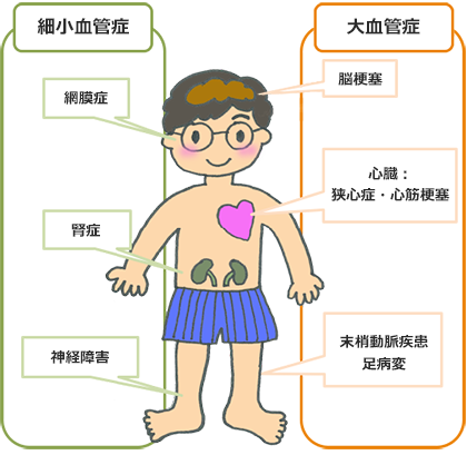 糖尿病の慢性合併症